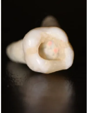 Figura  6  - Dente natural com  obturação  concluída e câmara  pulpar limpa.