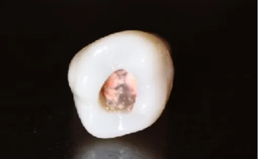Figura 13-  Kit  de obturação endodontica. Figura 14  - Réplica  do dente obturada com a  câmara  pulpar limpa.