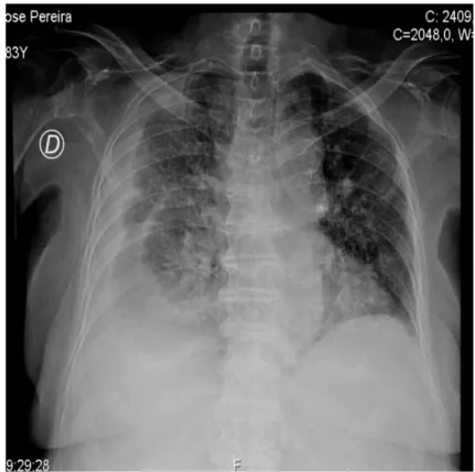 Figura 3: Radiografia do tórax que demonstra derrame pleural direito e reforço intersticial bilateral