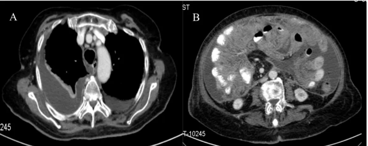 Figura 4: TC tóraco-abdomino-pélvica: A) derrame pleural bilateral mais acentuado à direita,  condicionando atelectasia do pulmão adjacente; B) aumento da espessura do grande epíploon e 