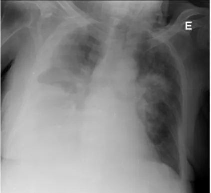 Figura 5: Radiografia do tórax com: derrame pleural à direita e espessamento pleural a condicionar  desvio do parênquima pulmonar; lesão nodular de limites mal definidos a nível para-hilar à 