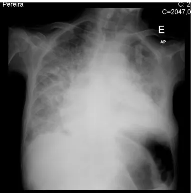 Figura 6: Radiografia do Tórax com hipotransparência da base esquerda (sobreponível a  radiografias anteriores) e da base direita (de novo)
