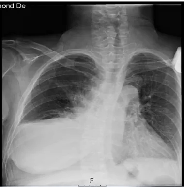 Figura 8: Radiografia do tórax: derrame pleural bilateral de maior extensão à direita e  alargamento do mediastino