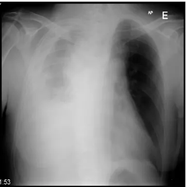 Figura 9: Radiografia do tórax que demonstra extenso derrame pleural direito. 