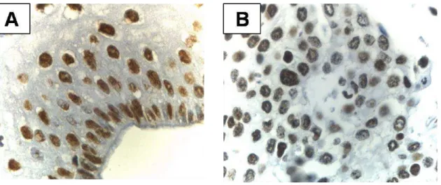 Figure 1: Photomicrographs of a squamous cell carcinoma with PTEN nuclear  immunostaining  in  normal  cervical  epithelium  (A)  and  cervical  CSCC  (B)