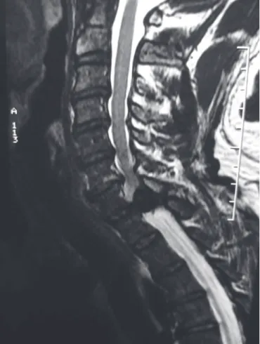 Figure 1A. Sagittal MRI showing posterior epidural hematoma