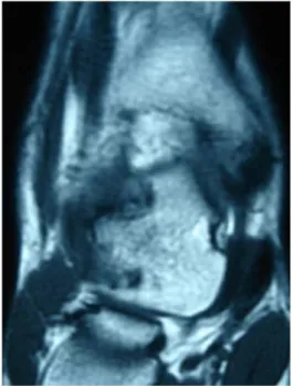 Figure 1. Case 1: MR image with talar neck irregularity