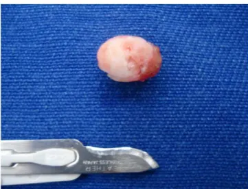 Figure 6. Case 2: Resected lesion
