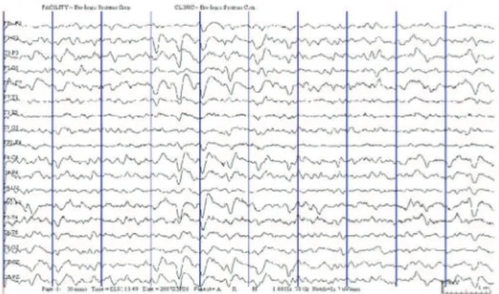 Figure 2. Second electroencephalogram showing generalized delta activities,  after cefepime was discontinued