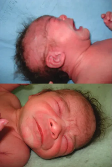 Figure 1. Newborn with birth weight, head circumference, length, palpebral  fissure and red upper lip border smaller than the 10 th  percentile for gestational  age, anteverted nose, smooth philtrum, low set pinna and abstinence syndrome 