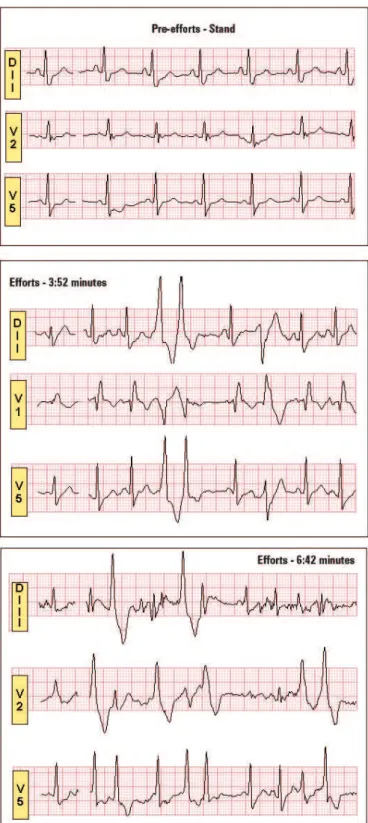 Figure 1. Isolated ventricular ectopy and coupled induced during  cardiopulmonary test