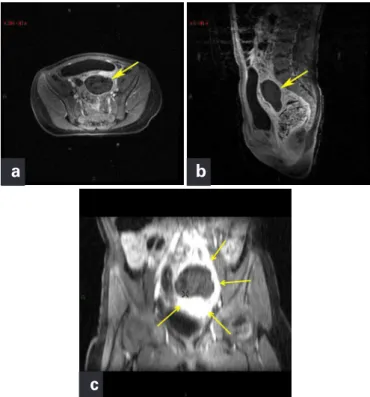 Figure 3. Weighted T2 images – (a) axial, (b) sagittal and (c) coronal – show  enlarged left ovary (arrows), with predominance of low signal, and small  peripheral follicles of up to 1 cm