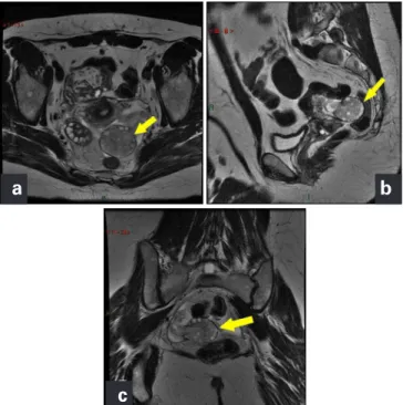 Figure 8. Weighted T2 image (sagittal) with fat suppression shows peripheral  distribution of follicles and excessive ovarian stroma with high signal