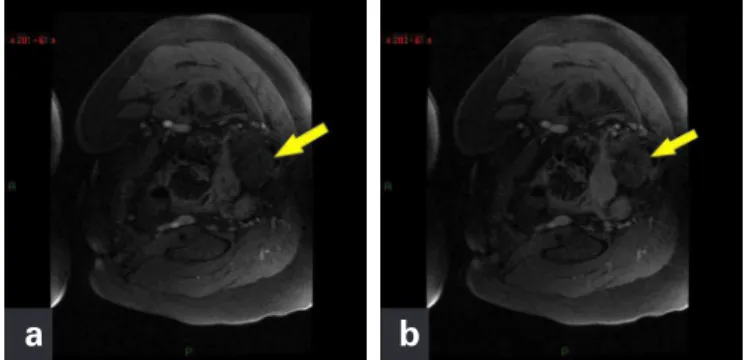 Figure 9. In weighted T1 images with fat suppression after early (a) and late (b)  contrast there is no satisfactory contrast of the ovary and tube on the left (arrows)