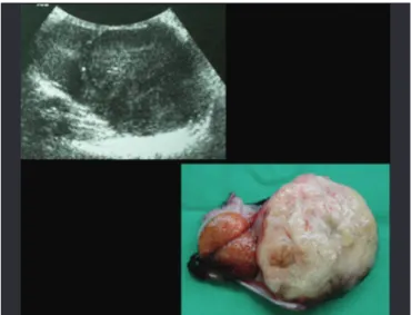 Figure 1. Sonographic and macroscopic aspect of right testis and paratesticular tumor