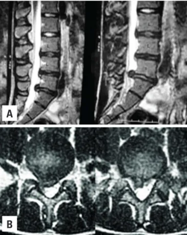 Figure 1. T2-weighted MRI showing lumbar disc herniation at the L5-S1 level. 