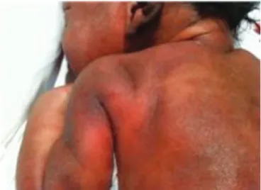 Figure 1. Injuries in newborn’s arm and shoulder