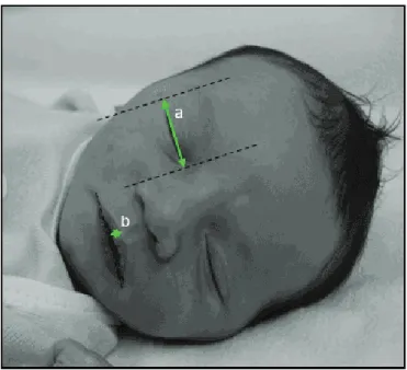 Table  1  shows  the  average  measurement  of  the  palpebral  fi ssure,  its  variation  and  standard  deviation,  as well as the measurement of the greatest width of the  vermilion border of the upper lip with its variation and  standard deviation.
