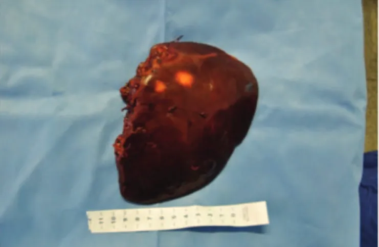 Figure 3. Surgical specimen – left hemi-hepatectomy (segments II-III-IV) from  giant multiseptated abscess in left lobe