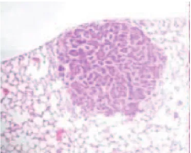 Figure 3. Photomicrography of pulmonary nodule stained by hematoxylin-eosin,  100X