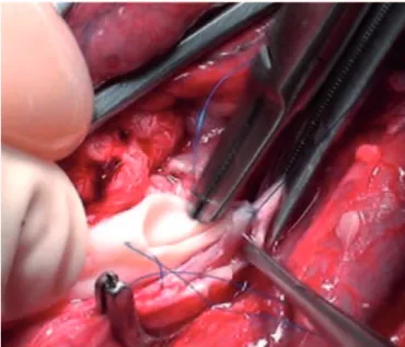 Figure 3.  End-to-side anastomosis, patch of the graft aorta to the recipient  infrarenal aorta 