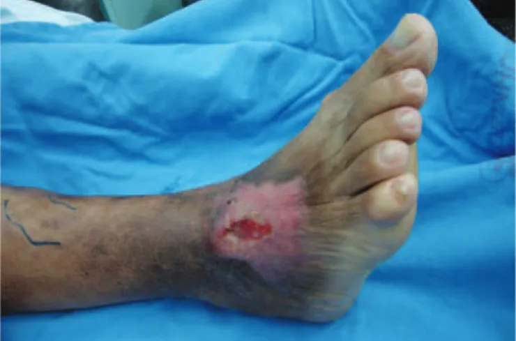 Table 1. Components and costs for application of simple wound dressingsFigure 1. Preoperative ulcers