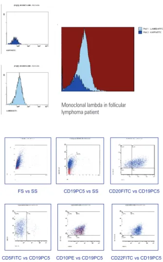 Figure 1. Flow cytometry analysis of axillary lymphadenomegaly of patient with  follicular lymphoma