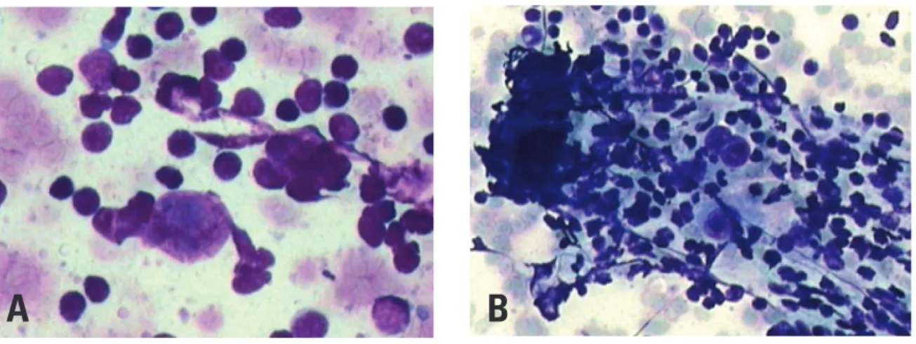 Figure 5. Fine needle aspiration biopsy showing, in cytology, cells with voluminous nuclei and evident nucleoli (A), sometimes multinucleated (B) diagnostic of Hodgkin  lymphoma (400x and 200x, respectively, hematoxylin-eosin)
