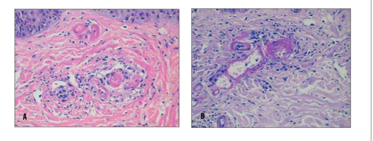 Figure 2. Derma presenting several capillaries with walls and thrombi composed with fibrin and eosinophilic substance