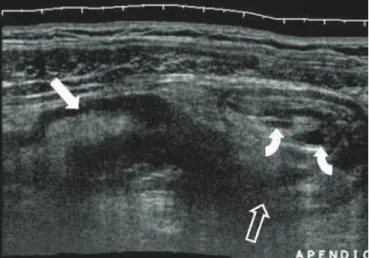 Figure 1. Right parasagittal panoramic image. Thickening of the cecum wall (bold  arrow) with a rigid thickened appendix, curved anteriorly (open arrow = base)