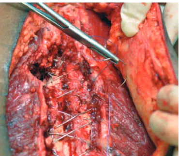 Figure 1. Dissection of the rectus abdominis fascia, keeping it attached to the  subcutaneous tissue