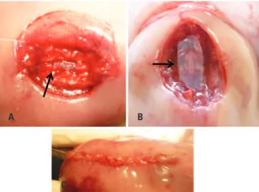 Figure 2. (A) Correction of the defect by means of neurosurgical technique. The  arrow shows the dura mater using continuous suture