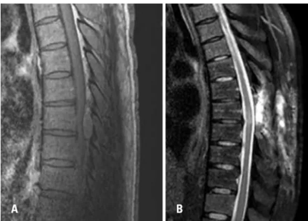 Figure 3. Sagittal T2 sequence thoracic magnetic resonance showing lesion  compression of spinal cord at T1-T2 (intradural meningioma), and CT scan  showing the complete resection (B)