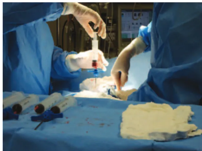 Figure 1. Bone marrow aspiration