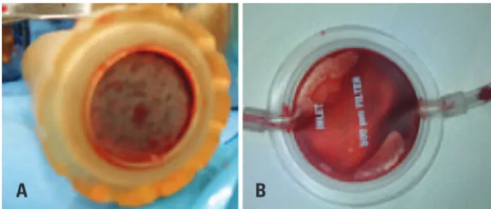 Figure 2. (A) Reusable filter. (B) Disposable filter