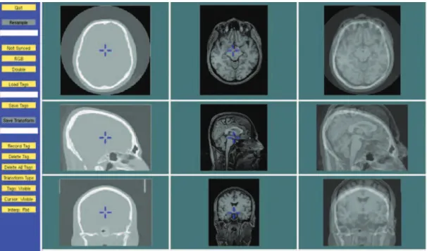 Figure 2. Screen shot of the Register software with the computerized tomography and magnetic resonance volumes misaligned