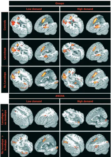 Figure 2. BOLD images for groups (controls, levodopa and non-levodopa  patients) and the comparison of them (levodopa > or < than non-levodopa) with  2 x 2 ANOVA, p<0.005