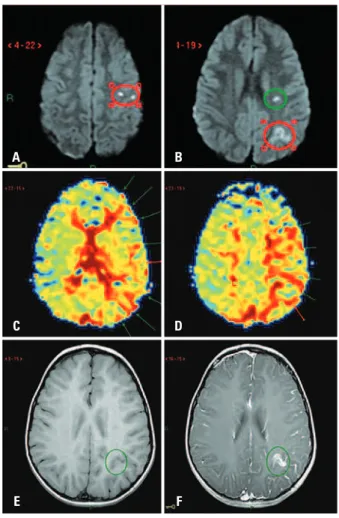 Figure 2. Magnetic resonance of the brain. Diffusion weighted images   (A and B) reveal areas of diffusion restriction in the centrum semiovale (green  circle), precentral gyrus and inferior parietal lobule (red circles)
