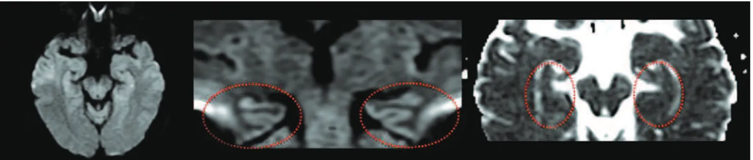 Figure 1. Diffusion sequences (axial and coronal, respectively) and ADC map (axial) on the first day of symptoms, highlighting the hippocampi (circles) that present with  no foci of diffusion restriction