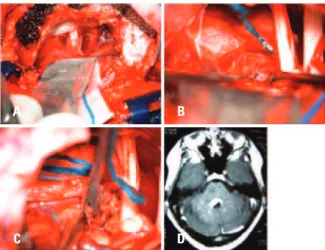 Figure 3. (A) Retrosigmoid approach; (B) surgical view of cavernoma in  brainstem surface; (C) surgical resection; (D) Postoperative magnetic   esonance imaging