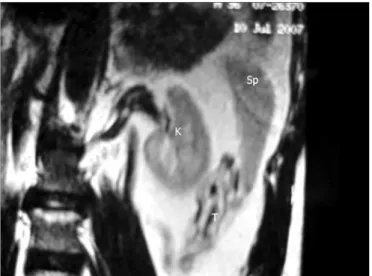 Figure 1. Magnetic resonance showing the left testis (T) below the spleen (Sp); 