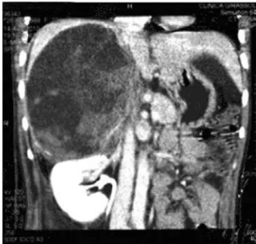 Figure 3. Identification of the retroperitoneal cystic mass and content aspiration