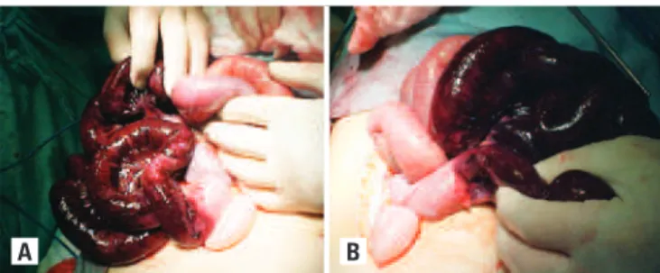Figure 1 A and B: Intraoperative ischemia and intestinal necrosis 
