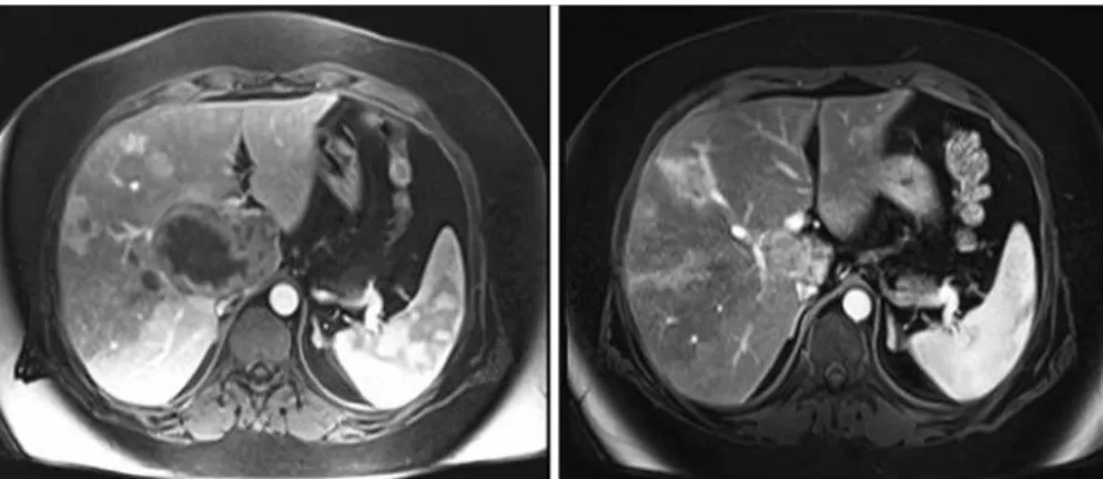 Figure 1. Angiography of the liver before and after embolization. Hypervascular lesions compatible with hepatic adenomas were observed in the liver right lobe, and  these lesions are absent in the angiography after embolization