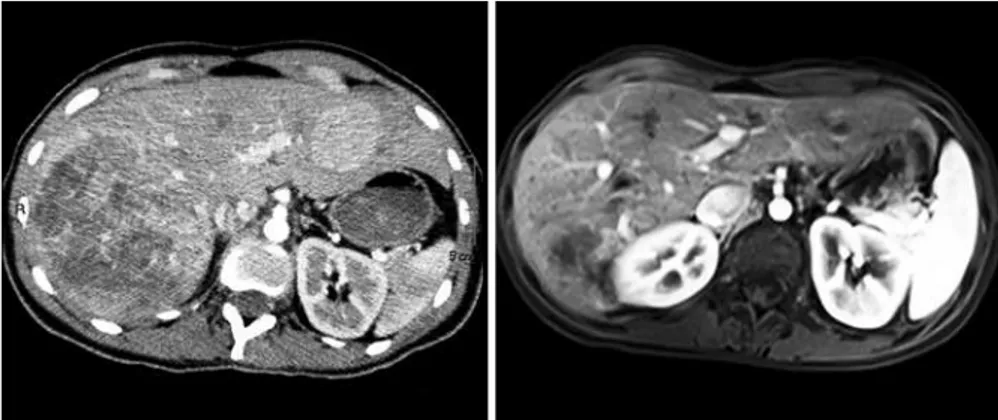 Figure 4. Tomography of the abdomen before embolization and control magnetic resonance imaging one year later