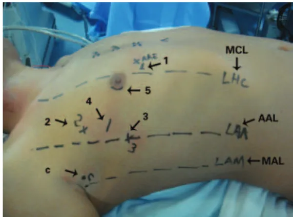 Figure 1. Preoperative markings and sites for the introduction of (1) left atrial  retractor; (2) left robotic arm; (3) right robotic arm, (4) working trocar; (5)  micro camera