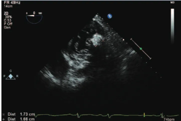 Figure 1. Apical 4-chambers view showing the mass located in posterior mitral  valve annulus