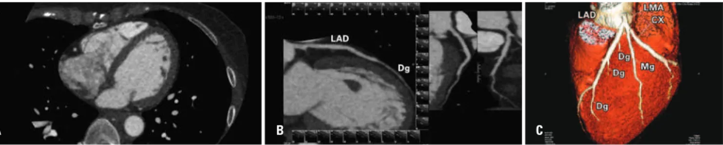 Figure 2. Coronary computed tomographic angiography examination with AIDR-3D. Axial image (A), curved-MIP (B) and 3D volume-rendering (C) reconstructions