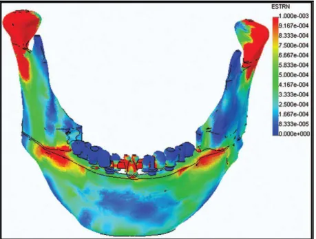 FIG. 9: Modelo de mandíbula em 3D e análise de elemento finito 