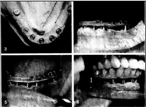 FIG. 14: Prótese com cantilever distal apoiada sobre os implantes distais 